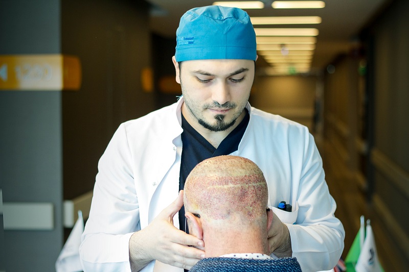 Haltbarkeit Haartransplantation Wie Lange Halten Transplantierte Haare Frag Doch Mich